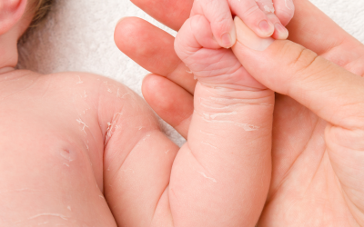 Common skin problems in infants