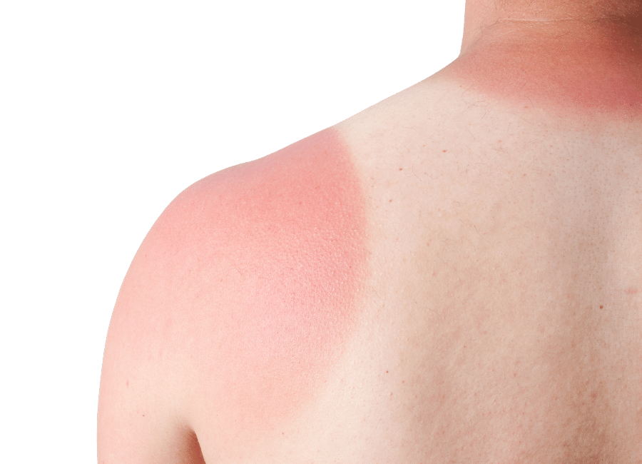 sunburn - skin cancer awareness