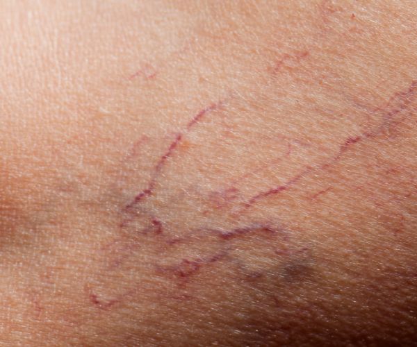causes of spider veins